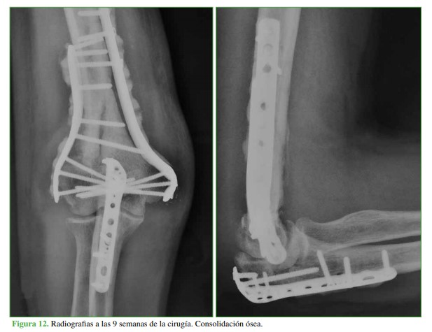 Empleo de osteosíntesis recubierta de cemento con antibiótico en el tratamiento de la osteomielitis. Presentación de dos casos