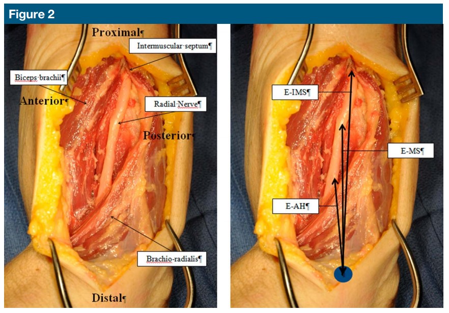 Fingerbreadths Rule in Determining the Safe Zone of the Radial Nerve and Posterior Interosseous Nerve for a Lateral Elbow Approach: An Anatomic Study