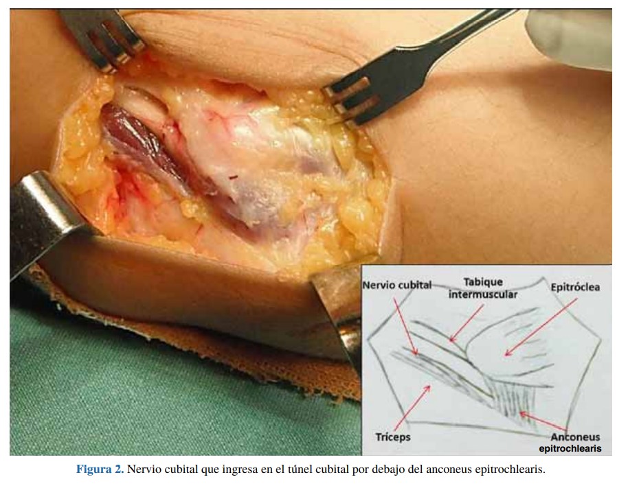 Síndrome del túnel cubital causado por el músculo anconeus epitrochlearis Reporte de un caso