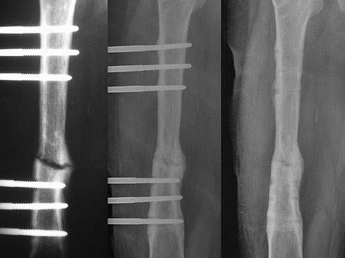 The Role of Extracorporeal Shockwave Treatment in Musculoskeletal Disorders