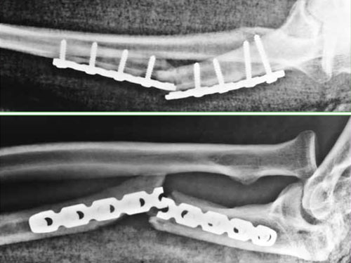 Empleo de osteosíntesis recubierta de cemento con antibiótico en el tratamiento de la osteomielitis. Presentación de dos casos