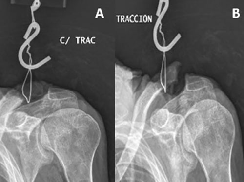 The medial coracoclavicular ligament: anatomy, biomechanics, and clinical relevance—a research study