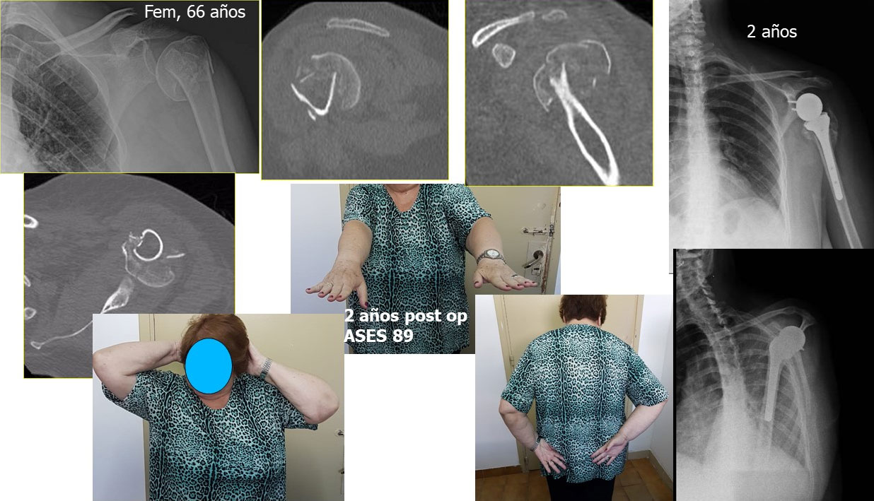 Prótesis reversa en fracturas del húmero proximal.