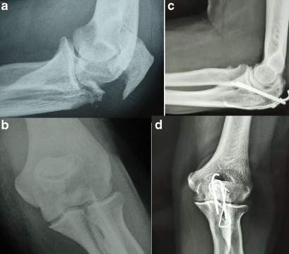 Olecranon fractures: do they lead to osteoarthritis? Long-term outcomes and complications