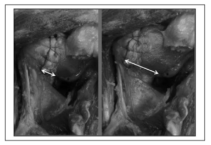 Change in the Distance From the Axillary Nerve to the Glenohumeral Joint With Shoulder External Rotation or Abduction Position